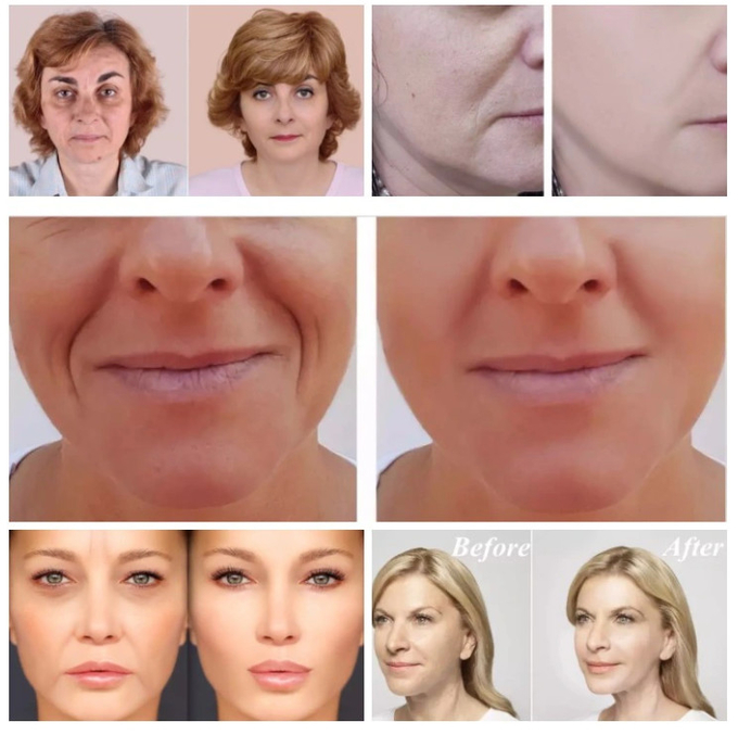 1.1ml Dermal Filling Revolax Fine Lips Facial Hyaluronic Acid Wrinkle Fillers