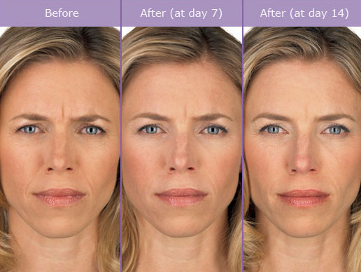 100iu Face Thinning Botox Botulinum Toxin Botulax 200 Units Type A Injection